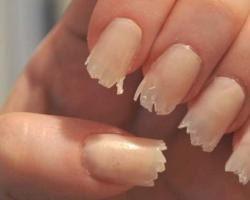 Дистрофия ногтей: причины, симптомы, лечение Дистрофия ногтевой пластины лечение